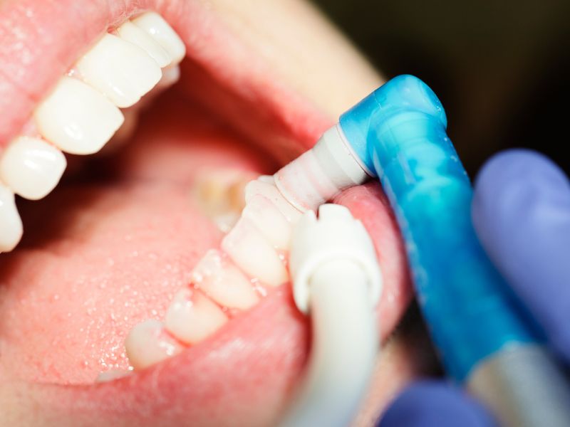 causas de la sensibilidad dental