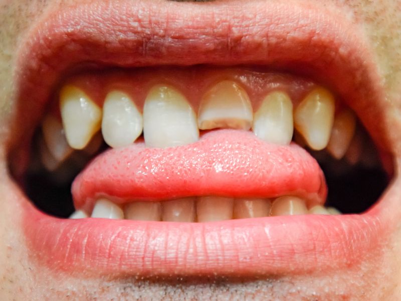 causas de la sensibilidad dental