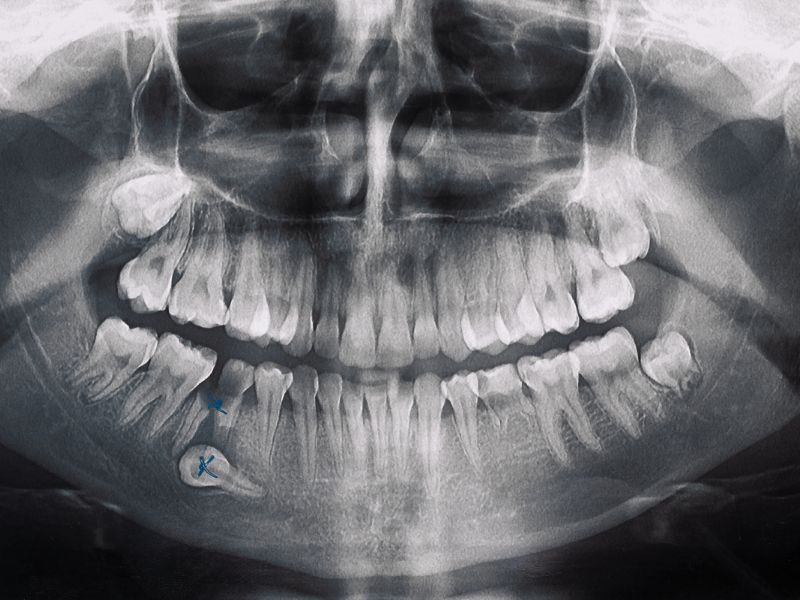 Radiografía Panorámica Dental | CLINICA DENTAL EL MAITEN