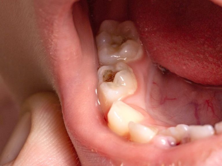 caries dental niños