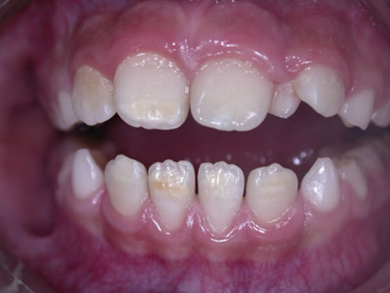 dientes con hipomineralización caries en niños