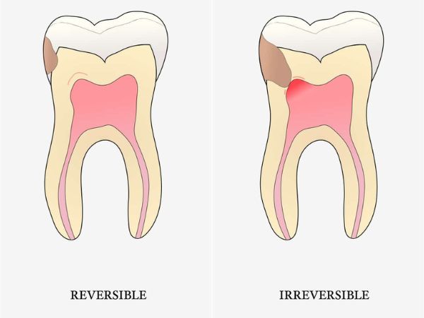 Pulpitis