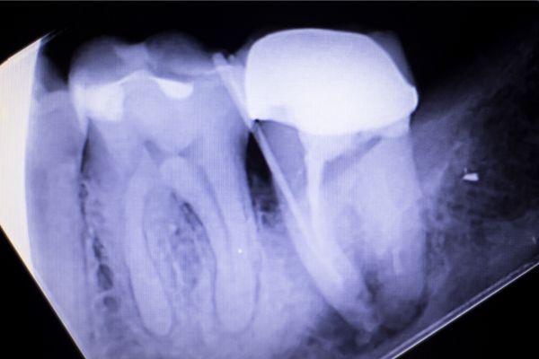 caries bajo coronas