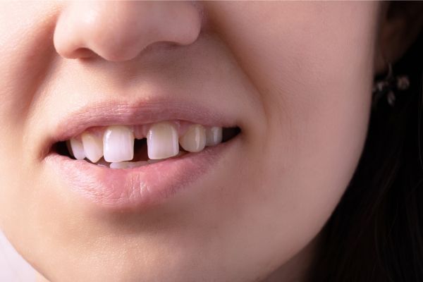 dientes separados