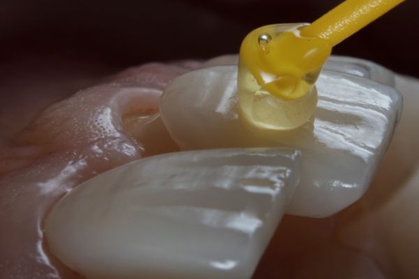 dientes separados