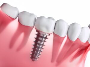 Implante dental