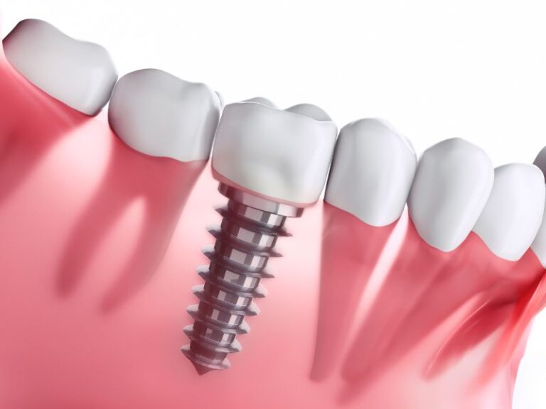 Implante dental